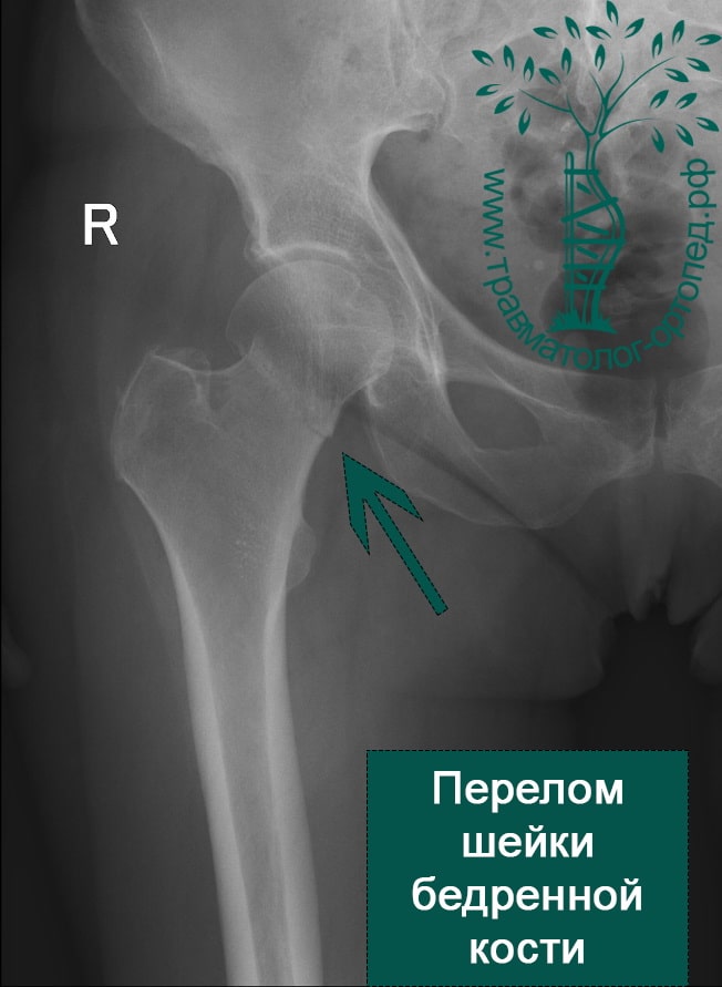 Реферат: Перелом шейки бедра